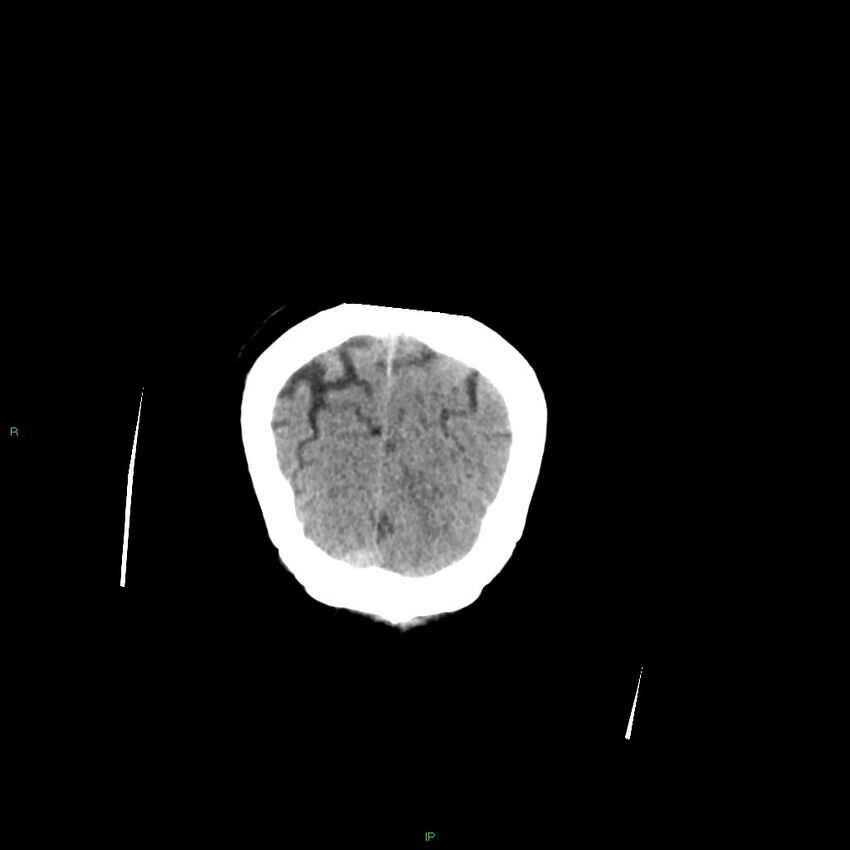 Basal ganglia hemorrhage (Radiopaedia 58349-65472 Coronal non-contrast 9).jpg