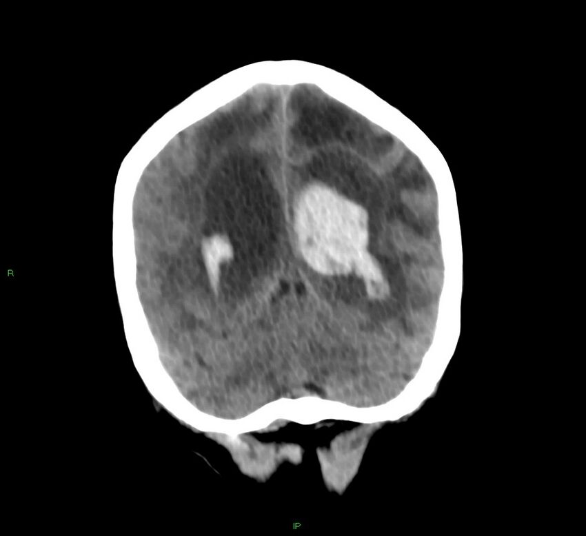 Basal ganglia hemorrhage (Radiopaedia 58766-65988 Coronal non-contrast 23).jpg