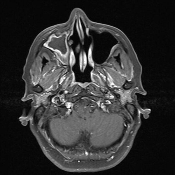 File:Base of skull chondrosarcoma (Radiopaedia 30410-31070 Axial T1 C+ fat sat 5).jpg