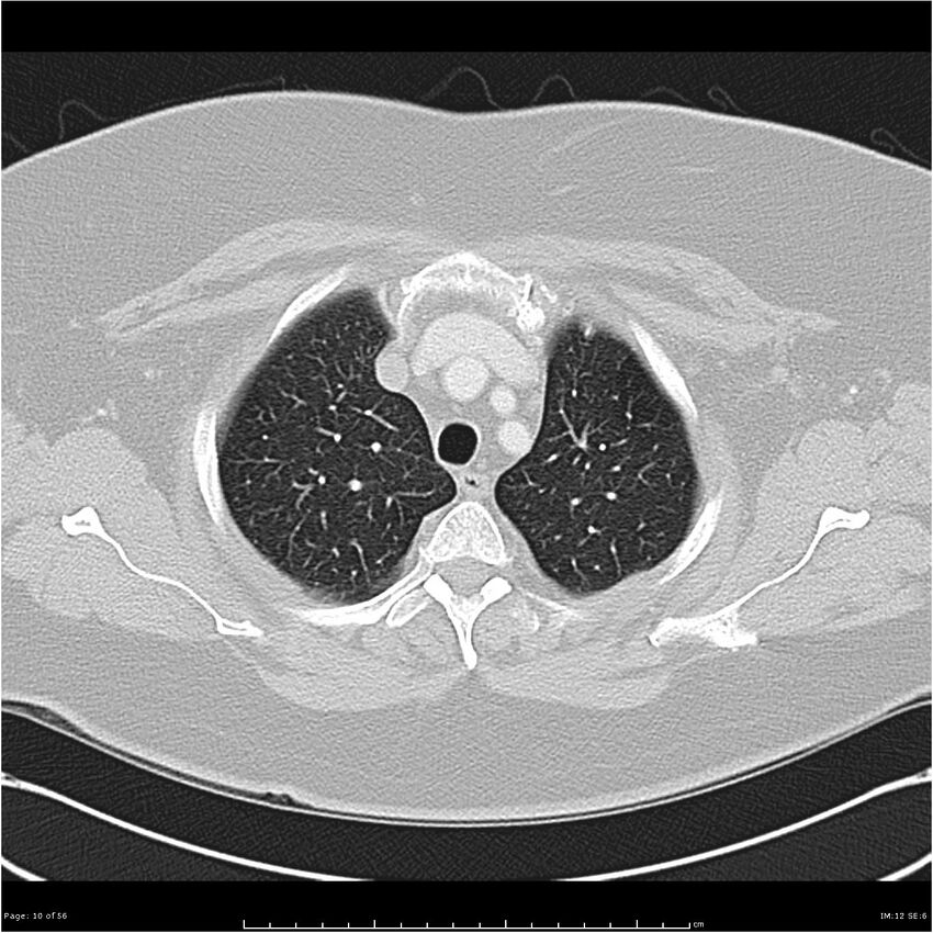 Benign metastasizing leiomyoma (Radiopaedia 26803-26962 Axial lung window 10).jpg