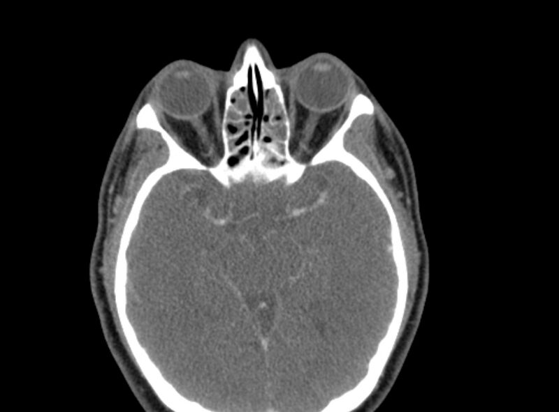 File:Benign mixed salivary tumor of the parotid gland (Radiopaedia 35261-36792 A 1).jpg