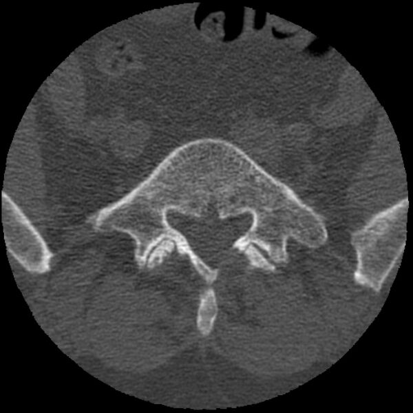 File:Bertolotti syndrome (Radiopaedia 24864-25128 Axial bone window 10).jpg