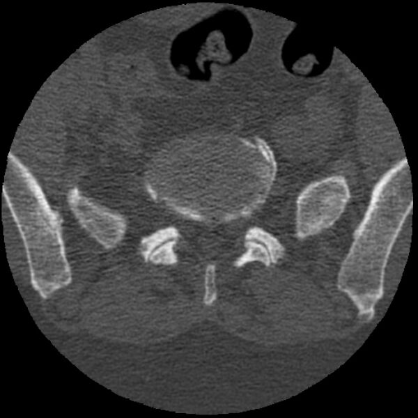 File:Bertolotti syndrome (Radiopaedia 24864-25128 Axial bone window 29).jpg