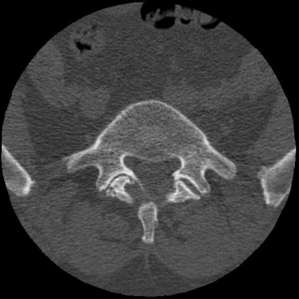 File:Bertolotti syndrome (Radiopaedia 24864-25128 Axial bone window 6).jpg