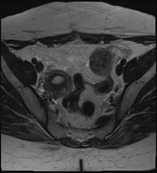 File:Bicornuate, unicollis uterus (Radiopaedia 79468-92593 Axial T2 7).jpg