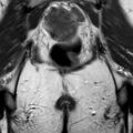 Bicornuate uterus (Radiopaedia 61974-70046 Coronal T2 26).jpg