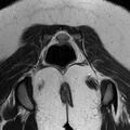 Bicornuate uterus (Radiopaedia 72135-82643 Coronal T2 16).jpg