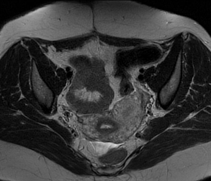File:Bicornuate uterus (Radiopaedia 76407-88114 Axial T2 12).jpg