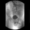 Bilateral duplex kidneys with left-sided uterocoele (Radiopaedia 20811-20726 A 4).jpg