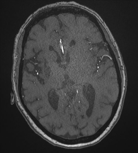 File:Bilateral fetal posterior communicating arteries (Radiopaedia 41286-44102 Axial MRA 115).png