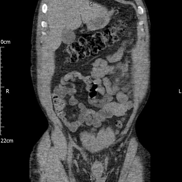 File:Bilateral medullary nephrocalcinosis with ureteric calculi (Radiopaedia 71269-81569 Coronal non-contrast 16).jpg