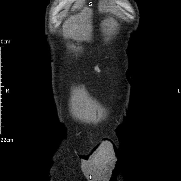 File:Bilateral medullary nephrocalcinosis with ureteric calculi (Radiopaedia 71269-81569 Coronal non-contrast 8).jpg