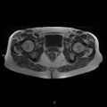 Bilateral ovarian fibroma (Radiopaedia 44568-48293 Axial T1 23).jpg