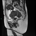 Bilateral ovarian fibroma (Radiopaedia 44568-48293 Sagittal T2 21).jpg