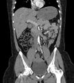 Bilateral ovarian mature cystic teratomas (Radiopaedia 79373-92457 B 28).jpg