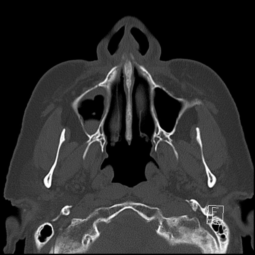 Bilateral palatine tonsilloliths on OPG and CT (Radiopaedia 75167-86247 Axial bone window 27).jpg
