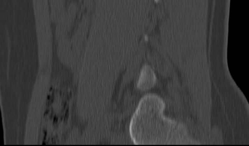 File:Bilateral pars defect (Radiopaedia 26691-26846 Sagittal bone window 14).jpg