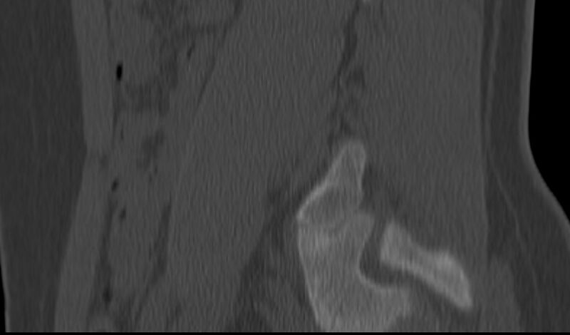 File:Bilateral pars defect (Radiopaedia 26691-26846 Sagittal bone window 51).jpg