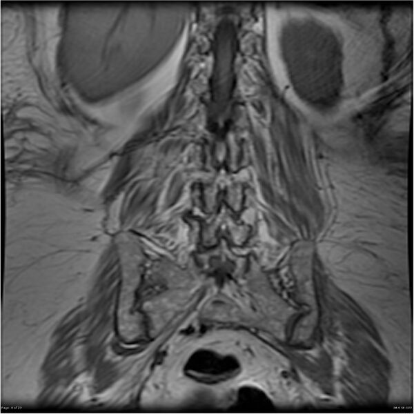 File:Bilateral psoas hematomas (Radiopaedia 24057-24280 B 6).jpg
