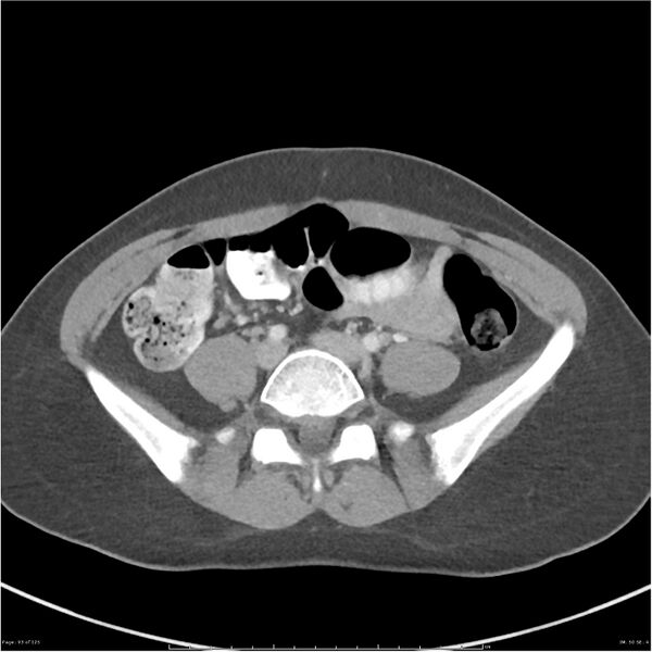 File:Bilateral ureteritis and cystitis (Radiopaedia 25340-25594 A 50).jpg