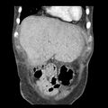 Biliary necrosis - liver transplant (Radiopaedia 21876-21846 C 6).jpg