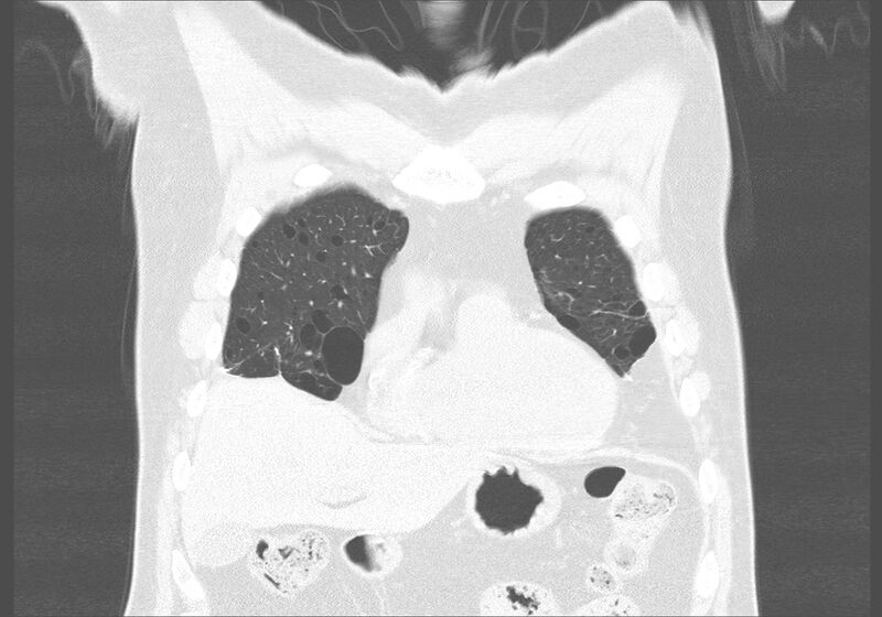 File:Birt-Hogg-Dubé syndrome (Radiopaedia 52578-58491 Coronal lung window 7).jpg