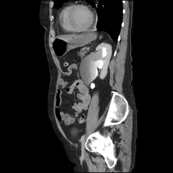 File:Bladder tumor detected on trauma CT (Radiopaedia 51809-57609 E 23).jpg