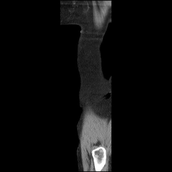 File:Bladder tumor detected on trauma CT (Radiopaedia 51809-57609 E 4).jpg