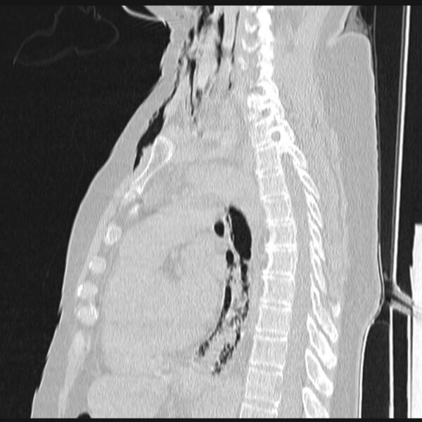 File:Boerhaave syndrome (Radiopaedia 45644-49799 Sagittal lung window 46).jpg