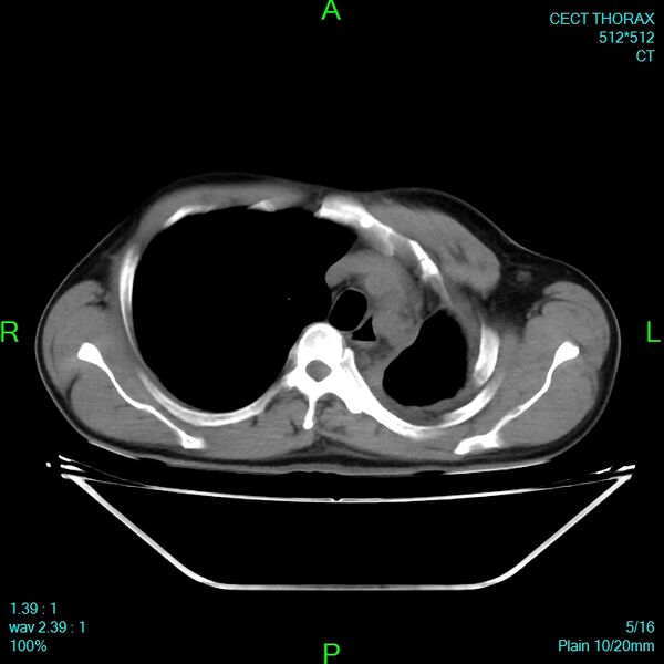 File:Bone metastases from lung carcinoma (Radiopaedia 54703-60937 Axial non-contrast 5).jpg