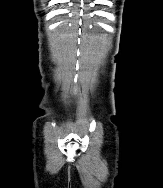 File:Bowel obstruction from colon carcinoma (Radiopaedia 22995-23028 C 70).jpg
