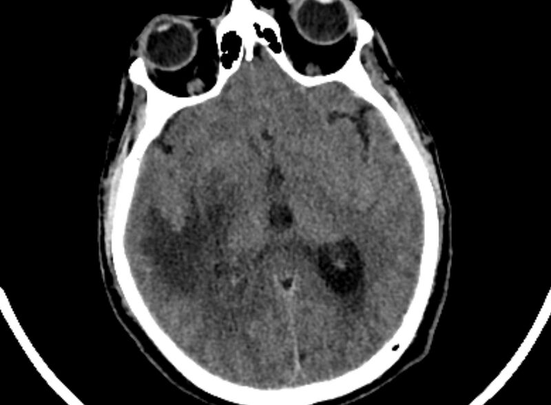 File:Brain abscess complicated by intraventricular rupture and ventriculitis (Radiopaedia 82434-96575 Axial non-contrast 38).jpg