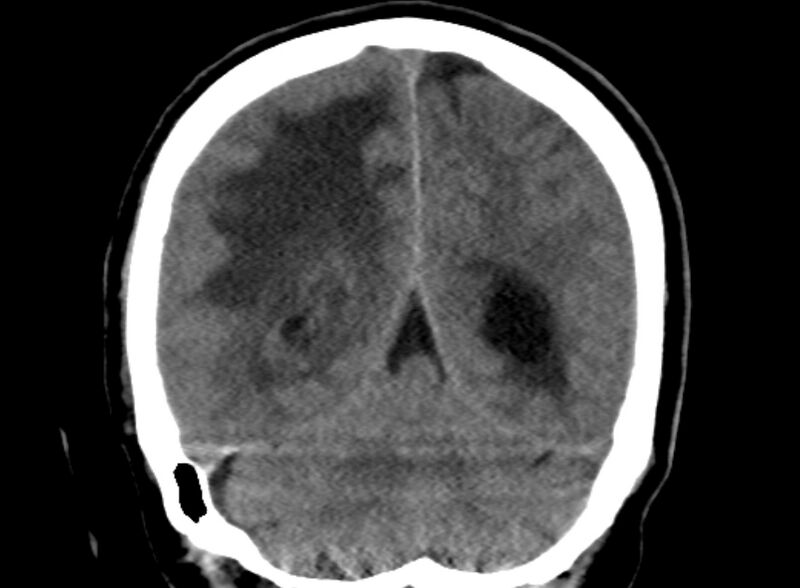 File:Brain abscess complicated by intraventricular rupture and ventriculitis (Radiopaedia 82434-96575 Coronal non-contrast 21).jpg