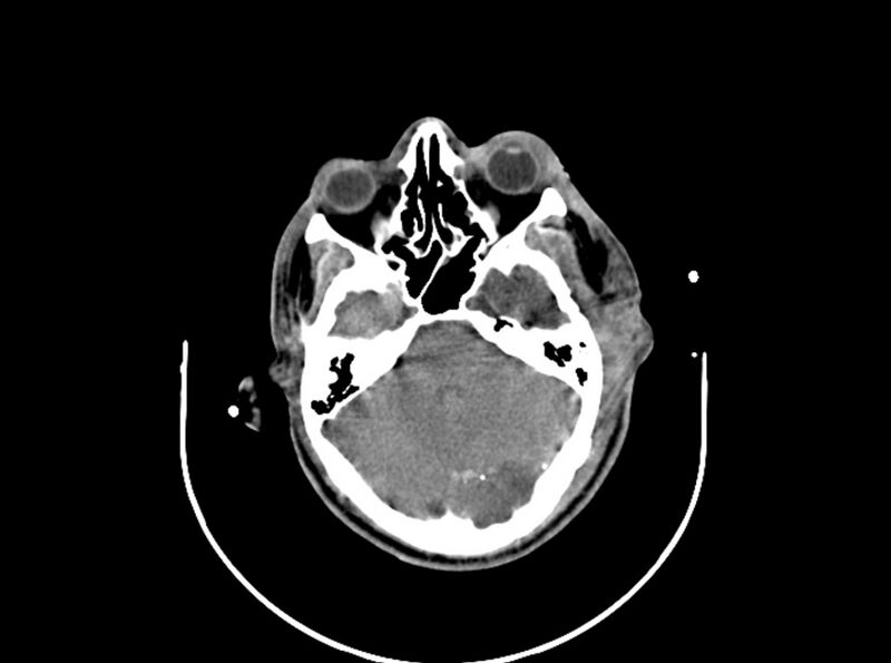 File:Brain injury by firearm projectile (Radiopaedia 82068-96087 B 70).jpg