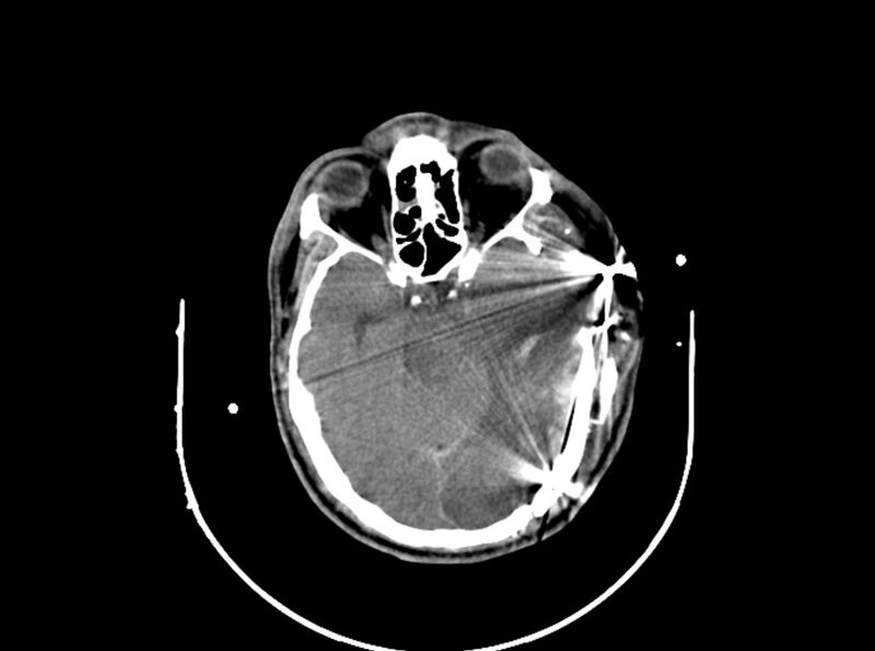 File:Brain injury by firearm projectile (Radiopaedia 82068-96087 B 84).jpg