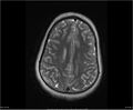 Brainstem glioma (Radiopaedia 21819-21775 Axial T2 29).jpg