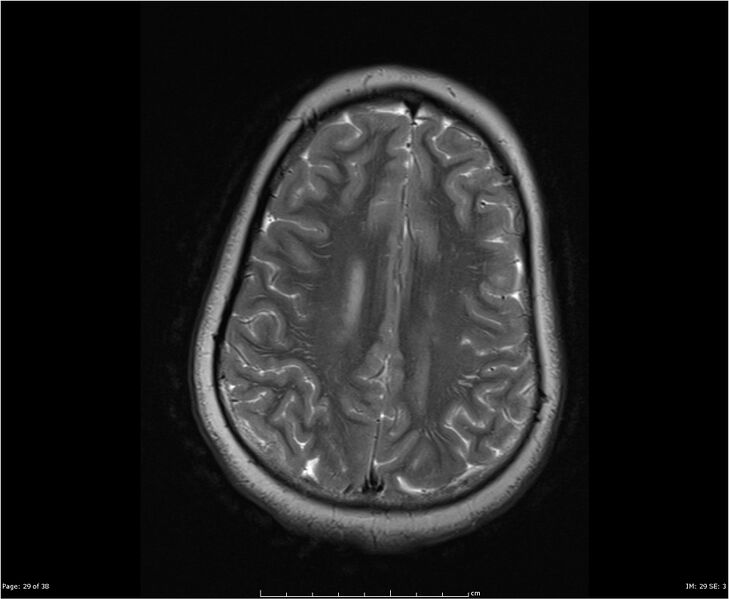 File:Brainstem glioma (Radiopaedia 21819-21775 Axial T2 29).jpg
