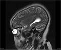 Brainstem glioma (Radiopaedia 21819-21775 Sagittal T2 22).jpg