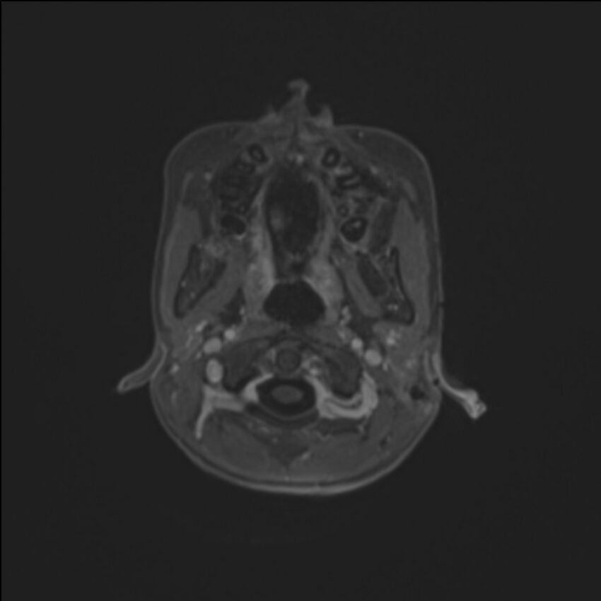 Brainstem glioma (Radiopaedia 70548-80674 Axial T1 C+ 12).jpg