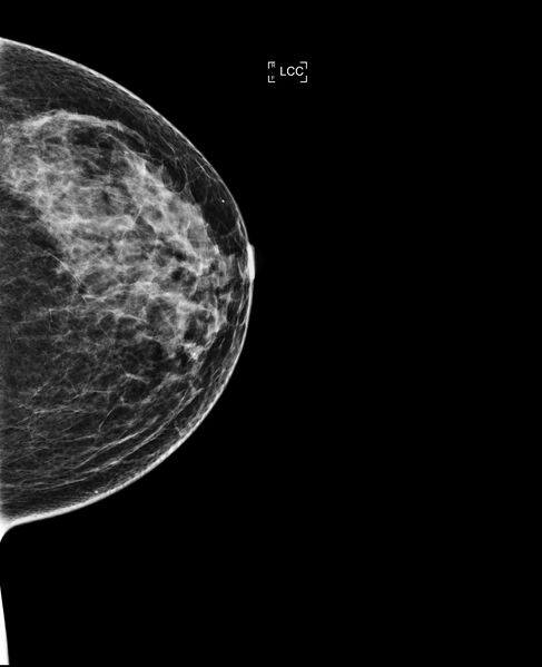 File:Breast hamartoma (Radiopaedia 63719-72417 D 1).jpg