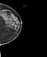 Breast hamartoma (Radiopaedia 63719-72417 D 1).jpg