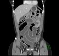 Broad ligament hernia (Radiopaedia 63260-71832 B 9).jpg