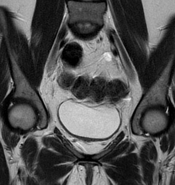 File:Broad ligament leiomyoma (Radiopaedia 81634-95516 Coronal T2 9).jpg