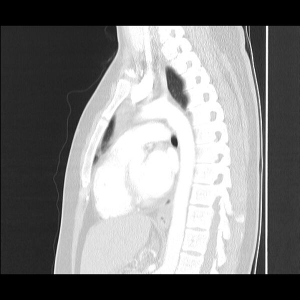 File:Bronchial atresia (Radiopaedia 22965-22992 Sagittal lung window 26).jpg