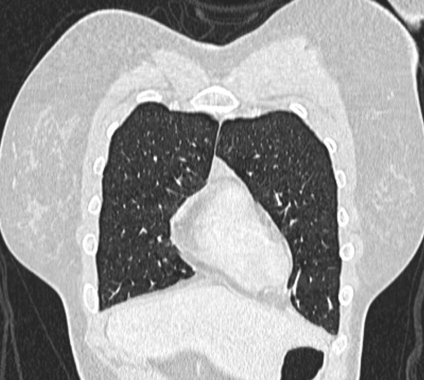 Bronchial atresia (Radiopaedia 50007-55297 Coronal lung window 12).jpg