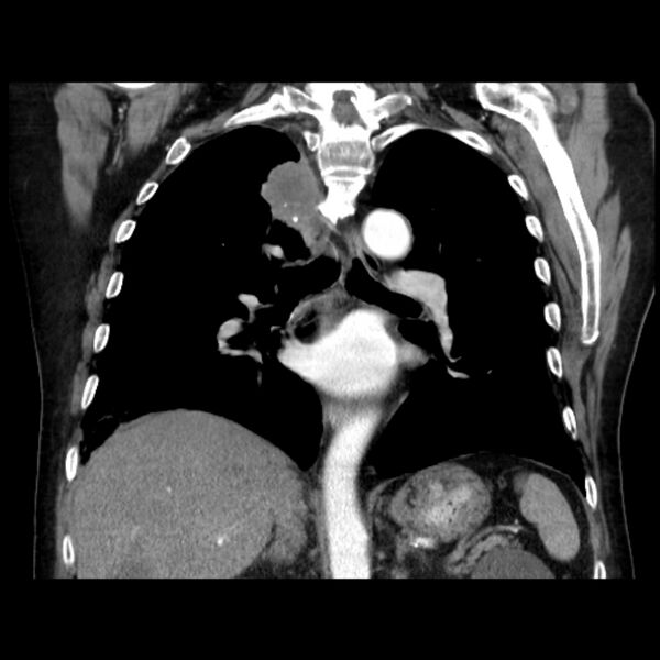 File:Bronchogenic adenocarcinoma and pulmonary embolism (Radiopaedia 9097-9806 C 30).jpg