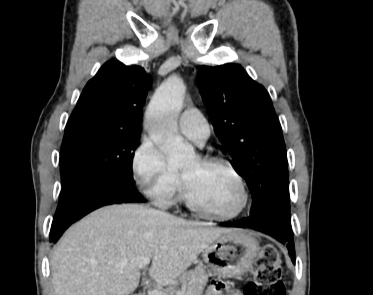 File:Bronchogenic carcinoma with superior vena cava syndrome (Radiopaedia 36497-38054 Coronal C+ delayed 1).jpg