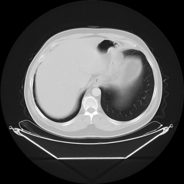 File:Bronchogenic carcinoma with upper lobe collapse (Radiopaedia 29297-29726 Axial lung window 29).jpg