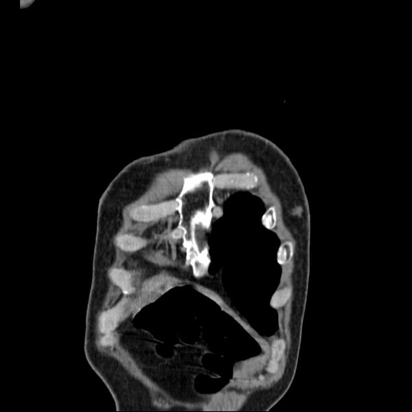 File:Bronchopleural fistula - postoperative complication (Radiopaedia 21020-20947 Coronal non-contrast 2).jpg