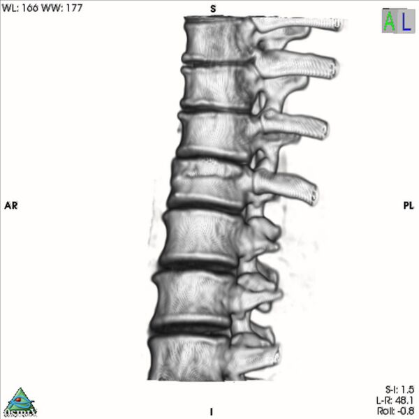 File:Bulging of paraspinal line in traumatic thoracal spinal compression fracture (Radiopaedia 29221-35872 3D VR 17).jpg
